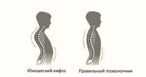 Кифоз фото до и после